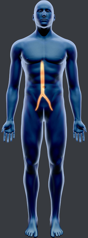 Aortic Intervention